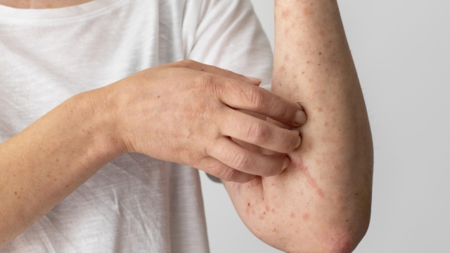 skin-allergy-reaction-person-s-arm